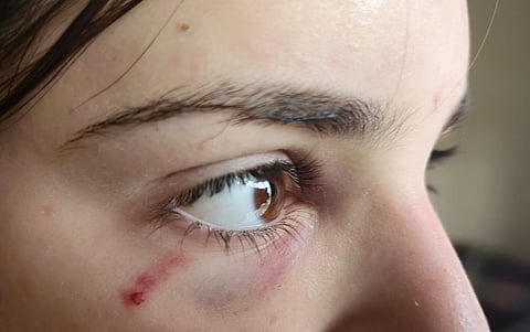 Two weeks after being attack, Shaked Tsurkan still bears the scars