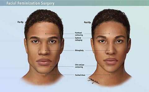 Ontario court rules taxpayers should not have to fund man’s ‘feminization’ face transplant 