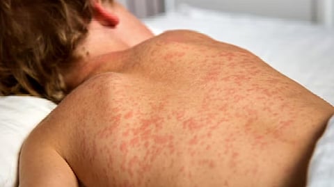Measles