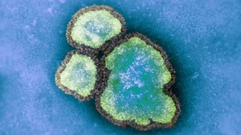 Measles