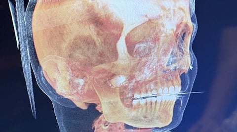 X-Ray of the victim