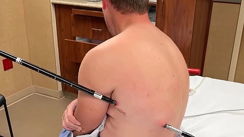 A hiking excursion took a serious turn after a man impaled himself with a trekking pole in a freak accident.