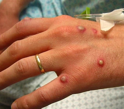 Belgium introduces compulsory monkeypox quarantine, US, Europe stockpile vax