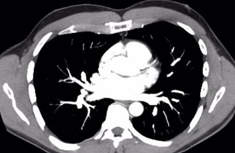 Doctor with pulmonary hypertension after COVID-19 vax suspects problem is widespread