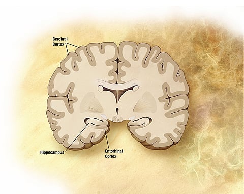 Ontario Alzheimer’s group praises promising treatment for disease