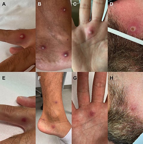 TRIPLE THREAT: Italian man tests positive for HIV, monkeypox and COVID on the same day