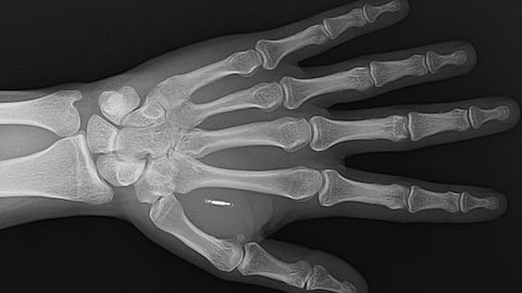 NOT A CONSPIRACY THEORY: WEF voices support for microchip implants