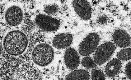 UPDATED: Canada now reporting 17 suspected cases of monkeypox