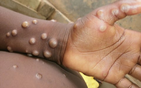 WHO renames monkeypox because scientists call it “discriminatory”