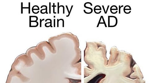 Ontario Alzheimer’s group celebrates positive trial results for disease’s treatment
