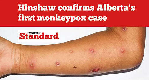 Hinshaw confirms Alberta's first monkeypox case