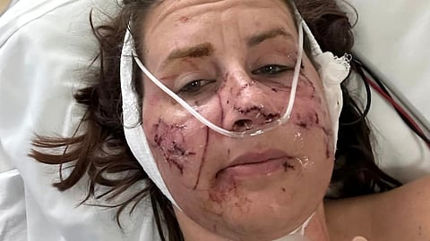 Montana woman survives 'vicious' otter attack while tubing