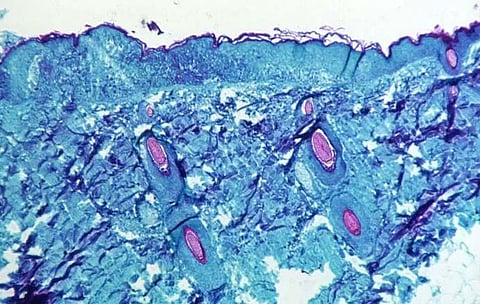 Canada now epicentre of global monkeypox outbreak, WHO convenes emergency meeting