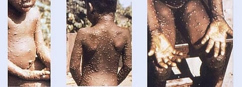 UPDATED: Europe monkeypox count in the dozens, first case now confirmed in US