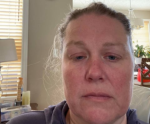 Calgary woman got Bell’s Palsy after Pfizer shot