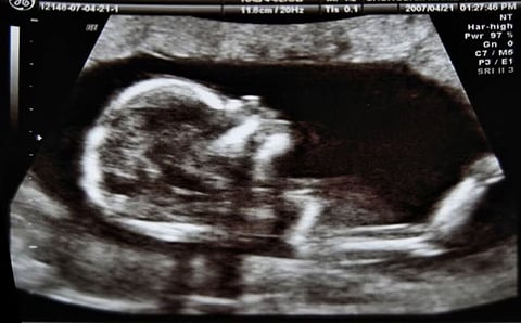 Ultrasound image 
